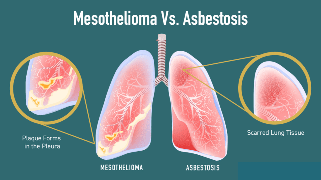 Mesothelioma Meaning in English